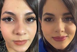 تزریق آنزیم بینی