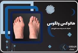 نمایش توضیحات درمان هالوکس والگوس