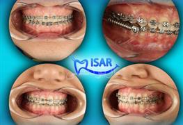 نمونه کار ارتودنسی دندان