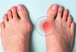 نمایش توضیحات درمان هالوکس والگوس یا شست کجی