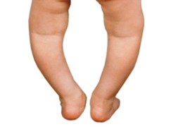 نمایش توضیحات درمان زانوی پرانتزی کودکان و بزرگسالان