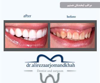 نمونه هایی از لمینت و کامپوزیت دندان