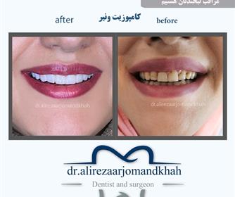 نمونه هایی از لمینت و کامپوزیت دندان