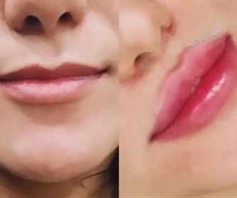 نمونه ای از تزریق ژل لب روسی
