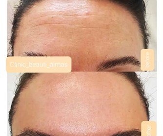 نمونه هایی از تزریق بوتاکس