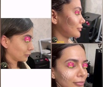 نمونه هایی از تزریق فیلر به گونه و چانه