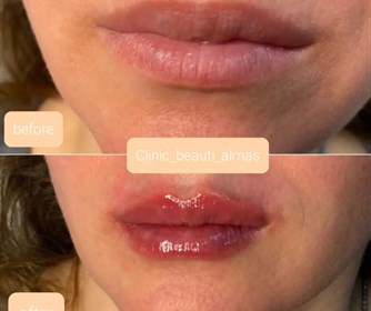 نمونه هایی از تزریق ژل لب