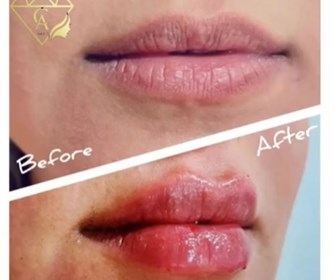 نمونه هایی از تزریق ژل لب