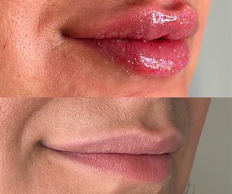 نمونه هایی از تزریق ژل و فیلر