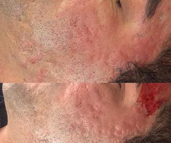 نمونه ای از رفع جای جوش