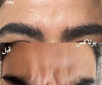 نمونه هایی از تزریق بوتاکس