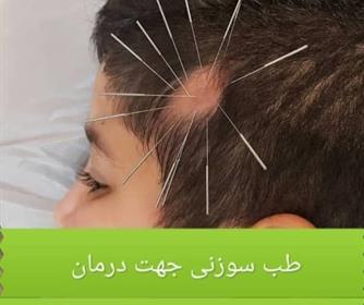 نمونه ای از طب سوزنی جهت درمان ریزش مو