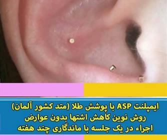 نمونه ای از ایمپلنت ASP جهت کاهش اشتها