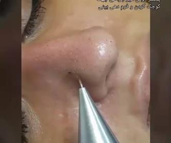 نمونه ای از پلکسر بینی در کلینیک