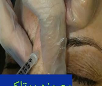 نمونه ای تزریق بوتاکس در کلینیک