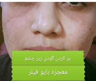 نمونه ای از تزریق فیلر در کلینیک