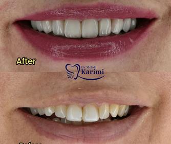 نمونه عکس هایی از لمینت دندان