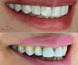 نمونه عکس هایی از کامپوزیت دندان