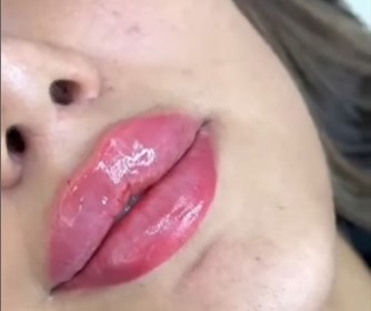 نمونه هایی از تزریق فیلر لب