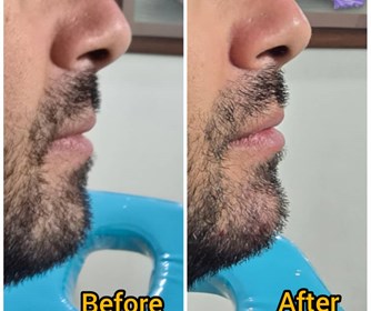 نمونه هایی از تزریق فیلر