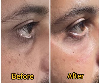 نمونه ای از تزریق فیلر زیر چشم