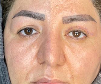 بلفاروپلاستی (عمل جراحی پلک)