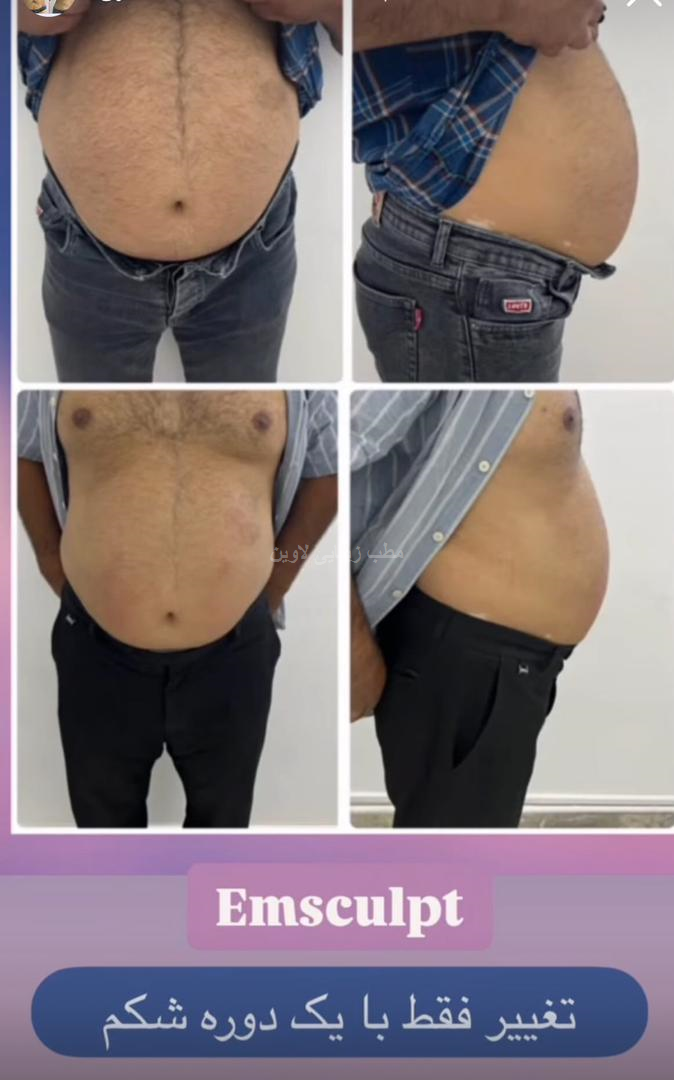 نمونه هایی از لاغری موضعی با دستگاه