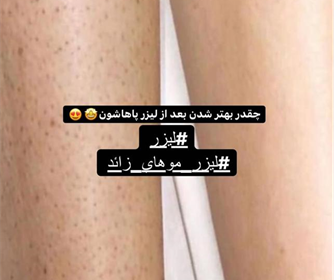 نمونه هایی از خدمات لیزر