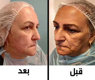 نمونه عکس هایی از هایفوتراپی