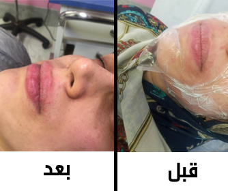 نمونه عکس هایی از ترزیق ژل