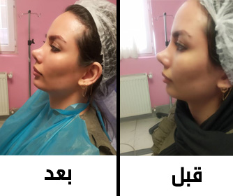 نمونه عکسی از زاویه سازی فک و چانه