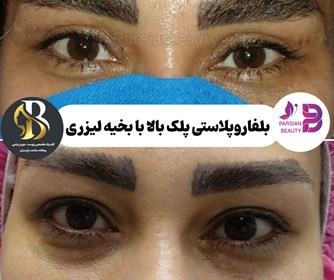 نمونه هایی از خدمات بلفاروپلاستی
