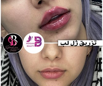 تزریق ژل لب