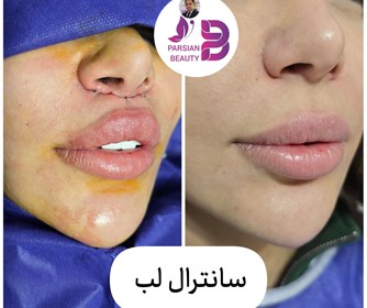لیفت سانترال لب