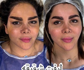 لیفت شقیقه