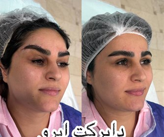 نمونه هایی از خدمات لیف ابرو