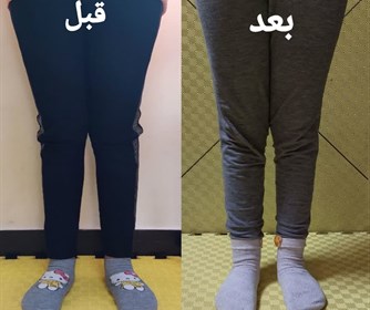 اصلاح زانوی ضربدری با کفی طبی